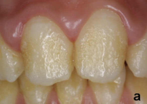 Hypoplastic amelogenesis imperfecta
